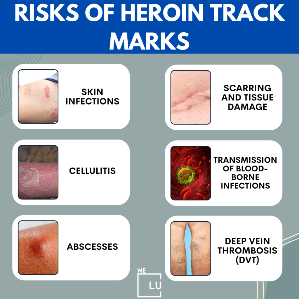 In addition to track marks, there are some other signs of heroin addiction, which include behavioral changes, other physical symptoms, and some other psychological and emotional signs.