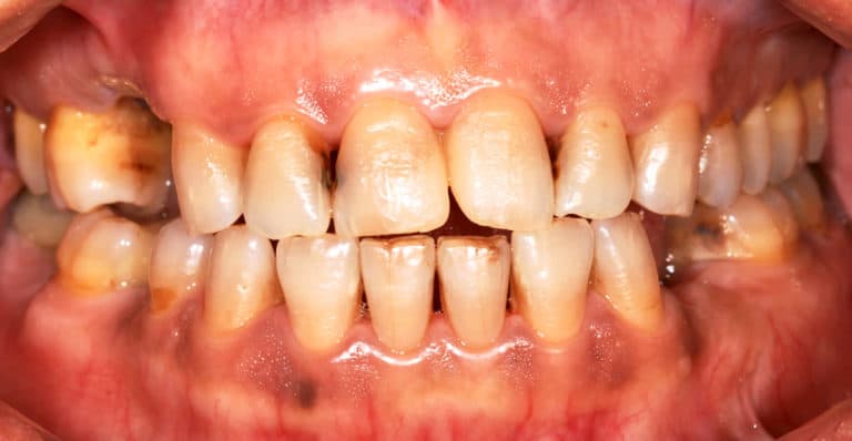 What is Meth mouth?